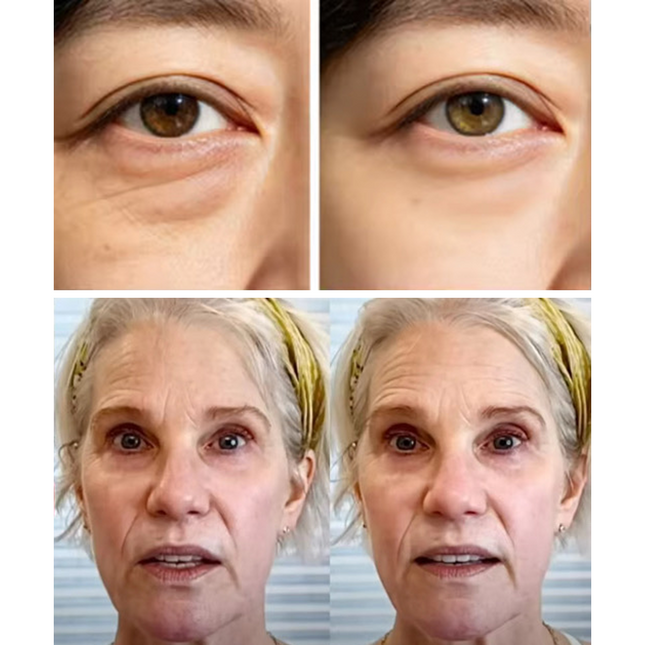 Dermion EyeLift™