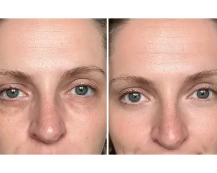Dermion EyeLift™