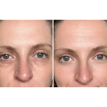 Dermion EyeLift™