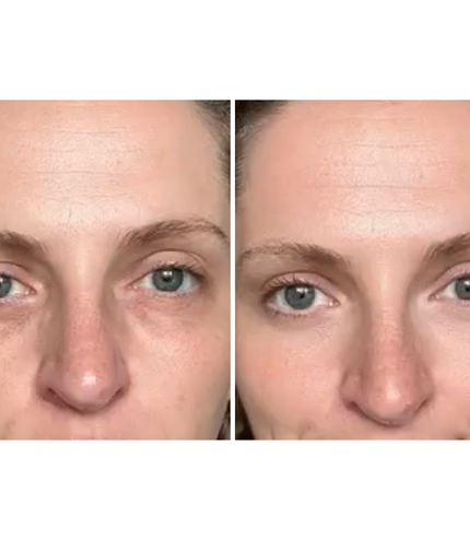 Dermion EyeLift™