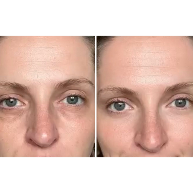 Dermion EyeLift™
