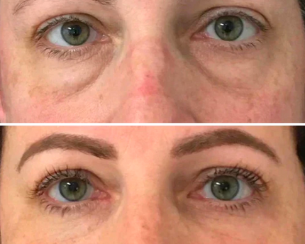 Dermion EyeLift™