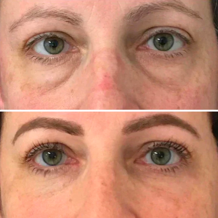 Dermion EyeLift™