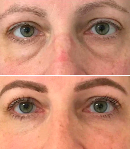 Dermion EyeLift™