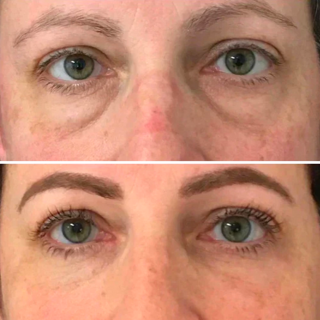 Dermion EyeLift™